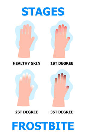 Frostbite stages info-graphic vector. Hypothermia in winter season. Problems with skin of frost fingers are shown.のイラスト素材
