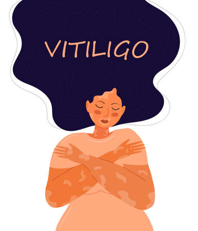 Vitiligo concept vector. World vitiligo day illustration. Disease of the skin and dermatological problems. Psoriasis, dermatitis, human rash are shown.のイラスト素材