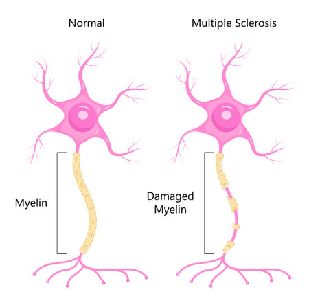 Neuron concept vector. Dendrite, axon, soma of neuron. Multiple sclerosis, nerve anatomy illustration.のイラスト素材