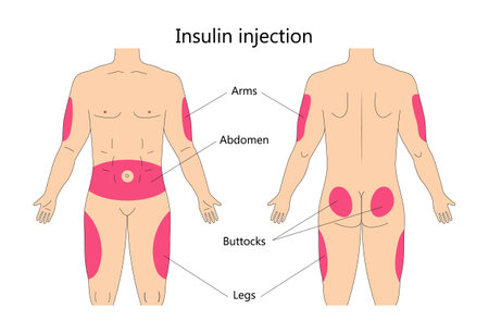 Insulin injection infographic vector. Diabetes treatment and insulin shots area on human body. Buttocks, upper outer arms and abdomen places.のイラスト素材