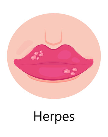 Herpes lips vector. Simplex virus infection causes recurring episodes of small, painful, fluid-filled blisters on skin, mouth, lips.のイラスト素材