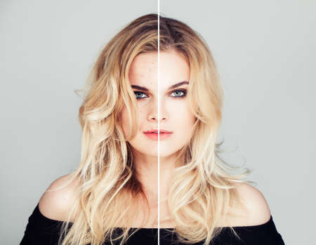 Young Model Woman with Skin Problem and Clear Skin Face Closeup Portrait. Unhealthy and Healthy Skin After Treatment. Facial Treatment, Medicine and Cosmetology Conceptの写真素材