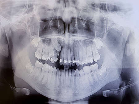 X-ray image of teenage teeth. Correction of bite and tooth extension