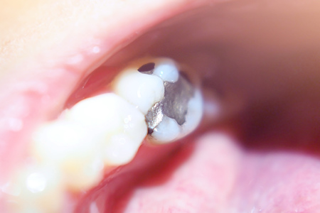 close up macro photo of Metall amalgam dental fillingsの写真素材