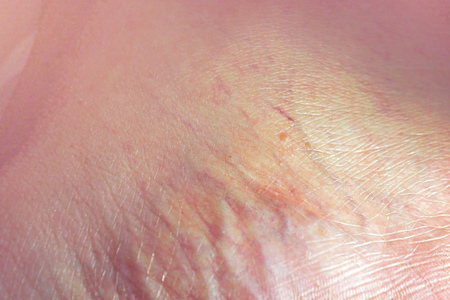close up sole foot with many blood veinsの写真素材