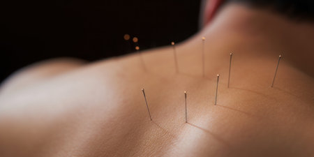 Close-up image of acupuncture needles in human skin.の素材
