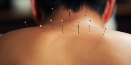 Close-up of acupuncture needles on patient's back.の素材