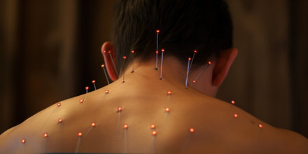 Person receiving acupuncture, a traditional Chinese medicine practice.の素材