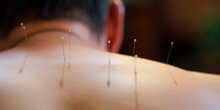Detailed view of acupuncture needles on patient's back.の素材