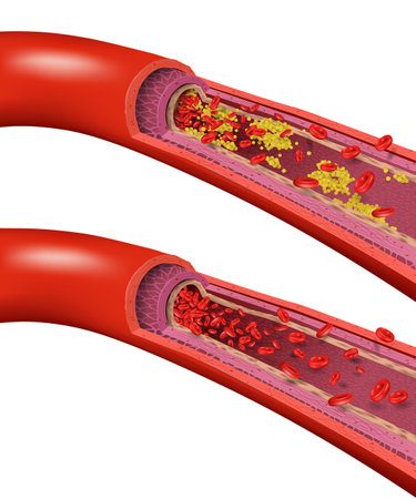 Healthy and Cholesterol Blocked Blood Vessels, medical concept on white background, realistic vector...