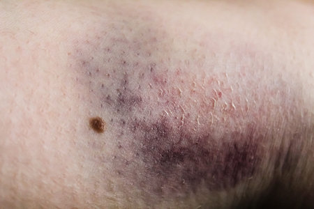 The surface of the skin displays a noticeable bruise with dark purple and brown hues, suggesting a recent trauma. The texture around the bruise appears slightly raised, indicating healing.の写真素材