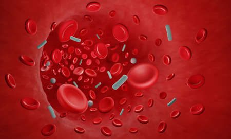 Sepsis or Bacteremia, bloodstream infection, bacteria in bloodの写真素材