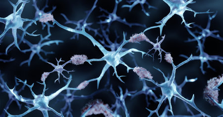Alzheimer's disease, Amyloid plaques aggregatesの写真素材
