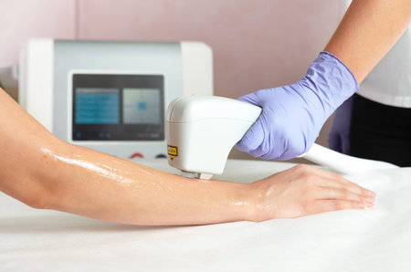 Laser hair removal of hands in a beauty salon. Hand hair removal procedure using laser hair removal...