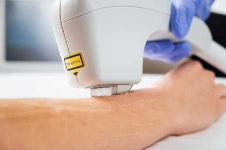 Laser hair removal of hands in a beauty salon. Hand hair removal procedure using laser hair removal technology. Close up.の写真素材