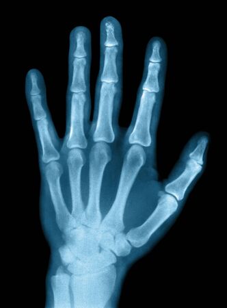 X-ray photograph. Scanned real x-ray filmの写真素材