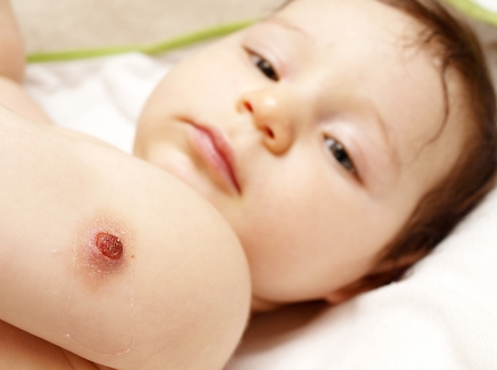 Cute baby girl laying on back, with BCG vaccination wound on shoulderの写真素材