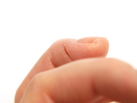 Closeup of wounded finger, isolated towards white backgroundの写真素材