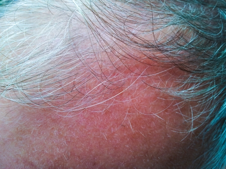 Closeup of person with grey hair, baldingの写真素材