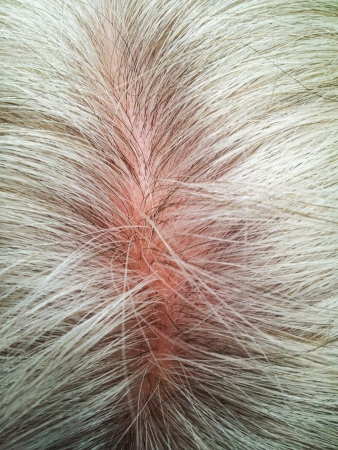 Closeup of person with grey hair, baldingの写真素材