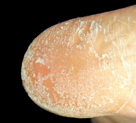 Closeup of skin peeling off from sole of foot towards blackの写真素材