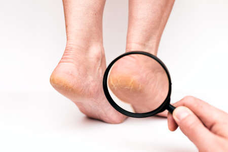 Closeup Highly dry heels woman on a white background through a magnifying glass.The doctors hand checks on how much cracked the skin is.の写真素材