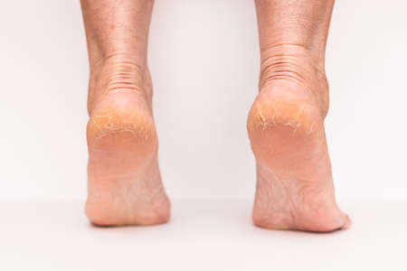 Closeup Cracks on woman Heels isolated white background.Health concept.の写真素材