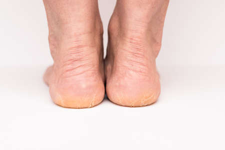 Back view of Closeup Cracks on woman Heels isolated white background.Health concept.