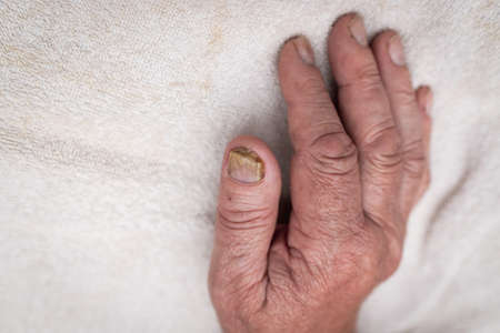 Nail fungus infection on the big finger. Fungal infection on nails hand, finger with onychomycosis.Close up.の写真素材