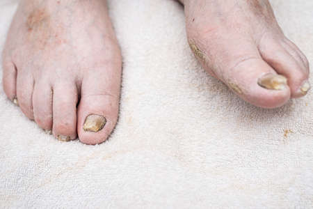 Fungus Infection on Nails of Man's Foot.White background,indoors shot.の写真素材