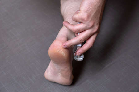 Close up of caucasian male dehydrated skin on the heels, trating callus, corn with scraper file, man removing corn, callus from his feet, masculine skin care, skin disease, fungal infection,healthcareの写真素材