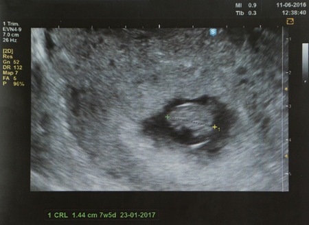 ultrasound of a fetus at 7 weeks 5 Days