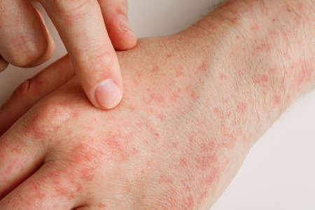 Hands with allergy reaction from taking medicines or wrong diet. By-effect, dermatology. Patient points on red spots on skin with forefinger, closeupの写真素材