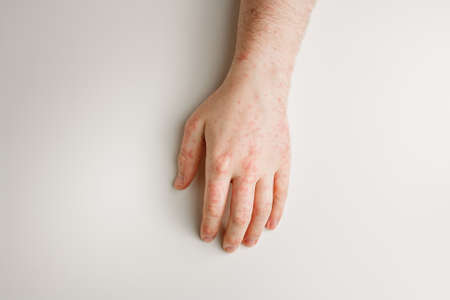 Male hand on white table with red spots on skin. Allergic reaction, skin problems, dermatology. Wrong diet, side effect from taking medsの写真素材