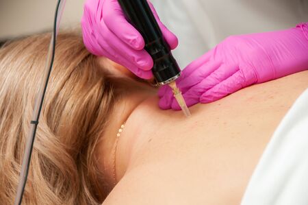 Pneumo puncture spa physiotherapyの写真素材