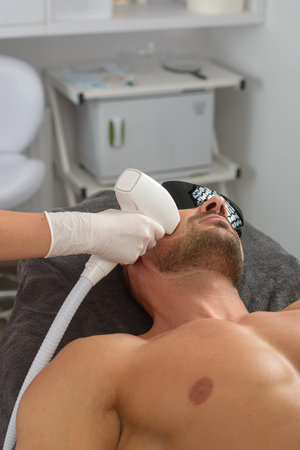 Laser hair removal on mans face. man in a goggles.の写真素材