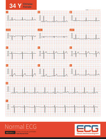 Normal electrocardiogram of a 34 year old Chinese healthy woman. The rhythm was sinus rhythm without other abnormal ECG changes.の写真素材