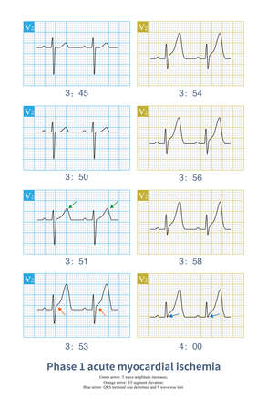 ale, 53 years old, chest pain for 3 months. The Holter captured the onset of myocardial ischemia, which was characterized by the towering T wave and the deformation of the end of QRS wave.の写真素材