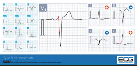 Male, 36 years old, without any clinical symptoms. Type B preexcitation was found in ECG, and the deduced accessory pathway was located in the right heart and posterior free wall.の写真素材