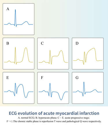 In ST segment elevation myocardial infarction, the ST-T of ECG will undergo a characteristic evolution process, and finally appear pathological Q wave, sometimes lasting for a lifetime.の写真素材
