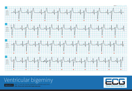 A 17 year old male was clinically diagnosed as ventricular septal defect and his ECG was ventricular bigeminy. Sinus and ventricular beats alternated.の写真素材