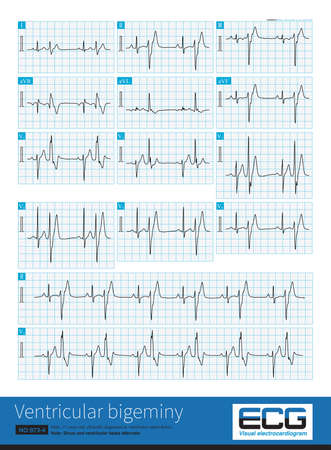 A 17 year old male was clinically diagnosed as ventricular septal defect and his ECG was ventricular bigeminy. VPCs originated in the left posterior fascicular region.の写真素材