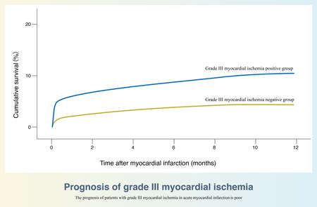 In AMI, patients with grade III myocardial ischemia on ECG suggest severe ischemia and poor long-term prognosis. V3-V4 leads S wave disappears or ST elevation amplitude beyond 50%の写真素材