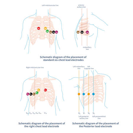 The chest electrode of ECG includes conventional chest lead, posterior wall lead and right ventricular lead. The placement of chest lead electrode shall comply with the specificatiの写真素材