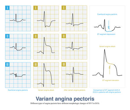 The ECG paper is composed of a small square with a side length of 1mm. The abscissa represents time and the ordinate represents amplitude or voltage.の写真素材