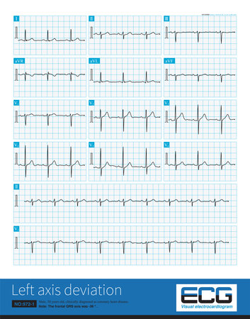 Male, 50 years old, suffering from coronary heart disease. The frontal QRS axis was -39 Â°, which was not enough to diagnose left anterior fascicular block. Lead II QRS main wave isの写真素材