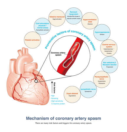 Smoking is the most dangerous factor for coronary artery spasm. Body inflammatory factors can also stimulate coronary artery spasm. Autonomic nerve tension can also trigger coronaryの写真素材