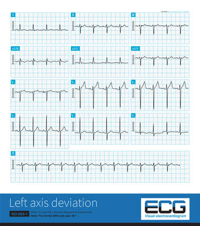 Male, 45 years old, suffering from hypertension. The frontal QRS axis was -38 Â°, which was not enough to diagnose left anterior fascicular block. Lead II QRS main wave is negative.の写真素材