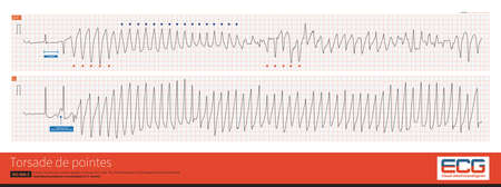 Torsade de pointes refers to the pleomorphic ventricular tachycardia that occurs in the background of long QT interval, and the polarity of QRS wave twists around the beseline.の写真素材