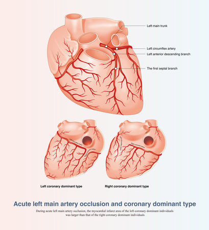 In acute left main artery occlusion, the myocardial infarct area of left coronary artery dominant individuals is larger than that of right coronary artery dominant individuals.の写真素材